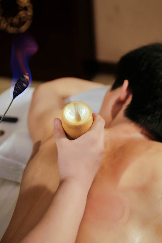 专业的保健技师为顾客进行吸筒疗法拔火罐
