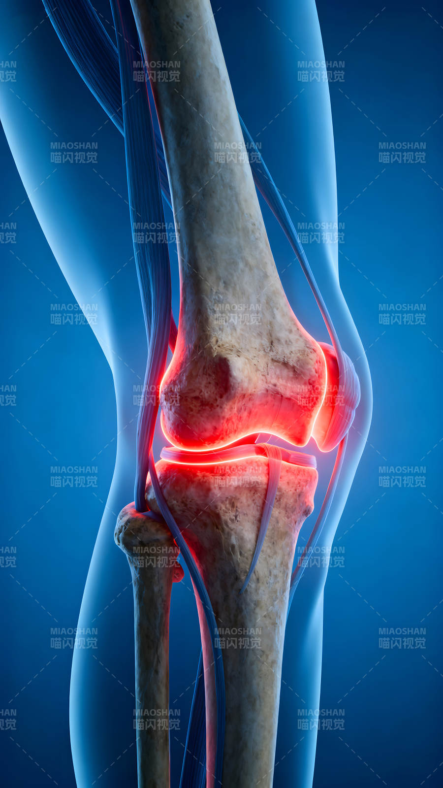 膝关节炎症示意图-图片