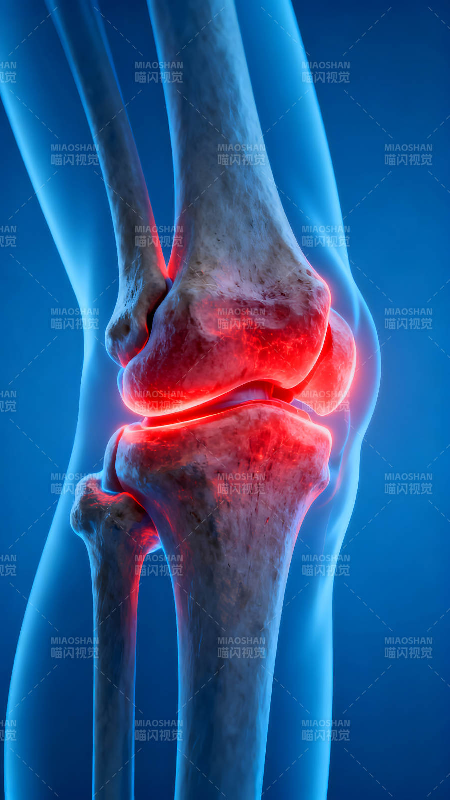 膝盖关节炎症图片-图片
