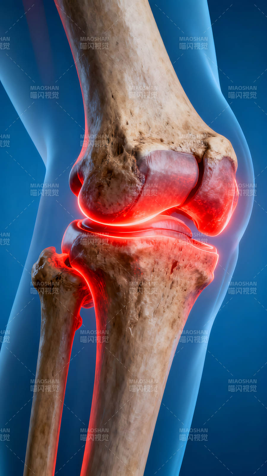 膝盖关节的解剖展示炎症发炎-图片