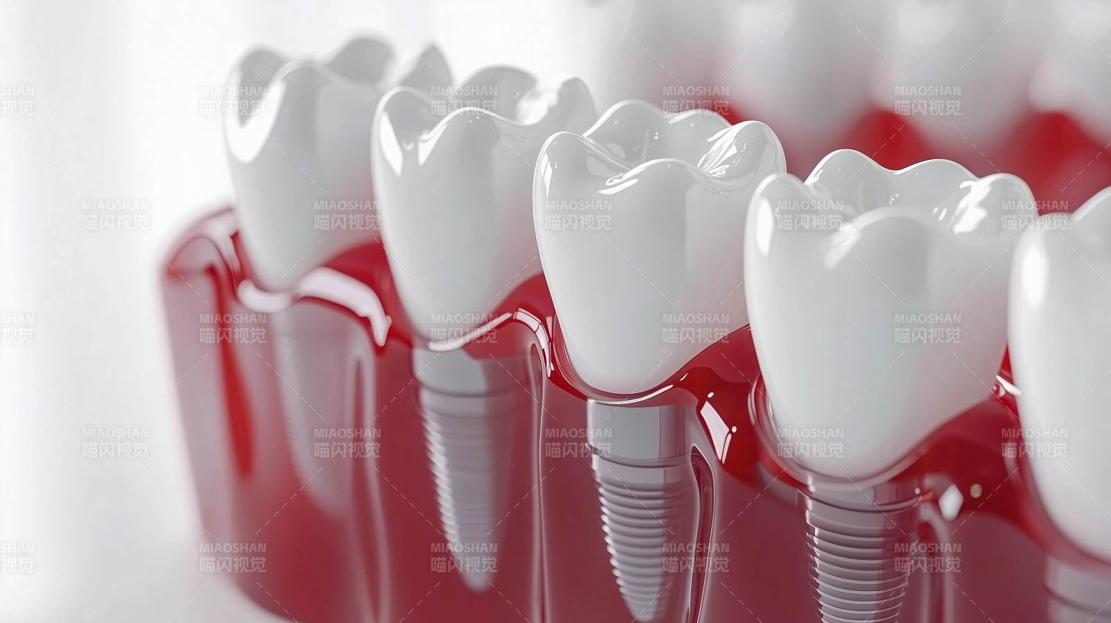 牙齿种植模型展示图片