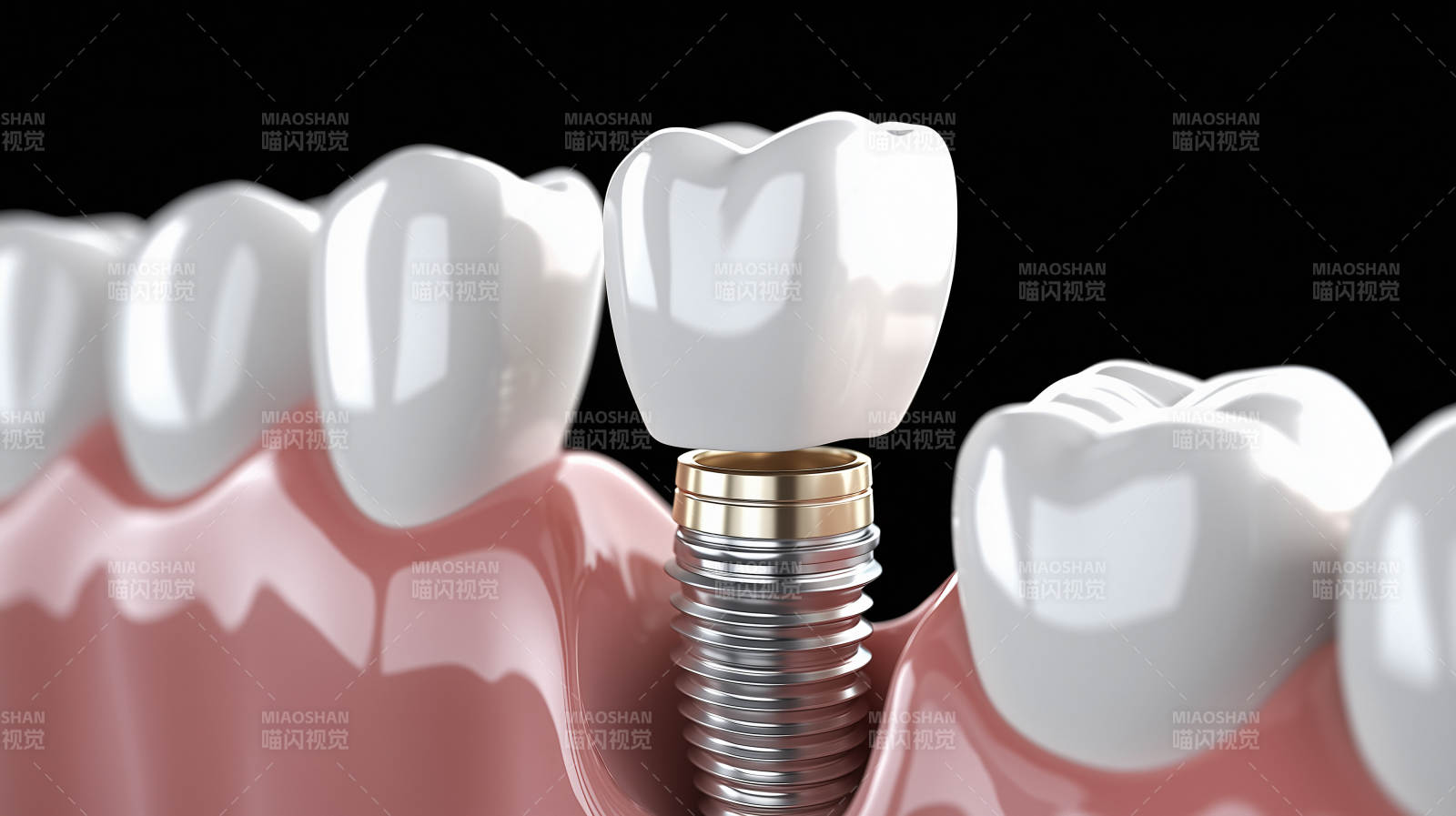 牙科种植体示意图图片