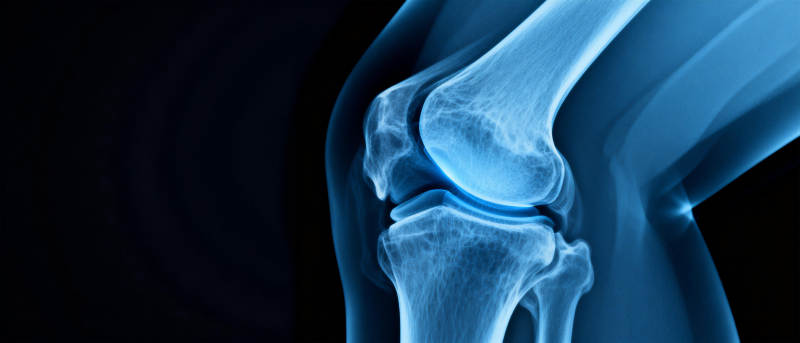 膝关节X光影像图片