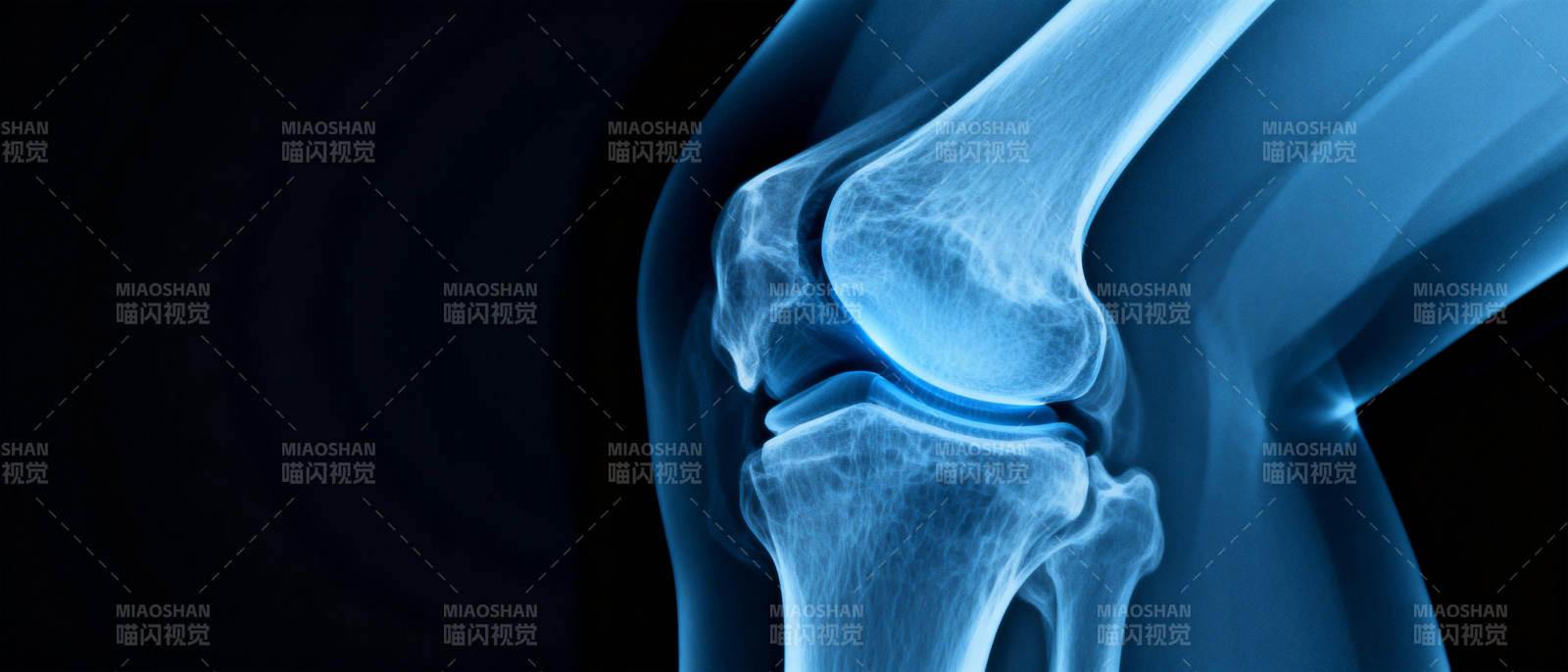膝关节X光影像图片