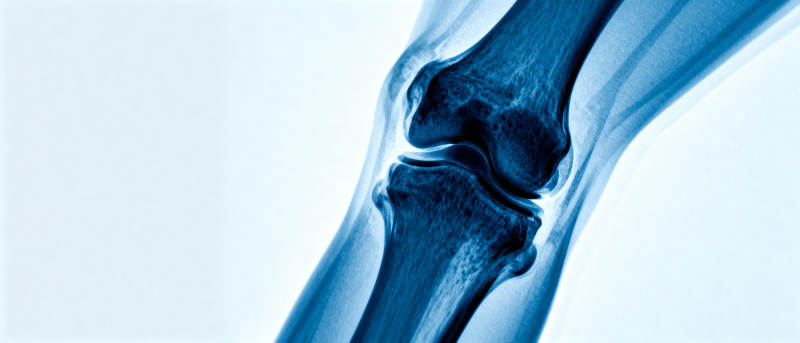 膝关节X光影像图片