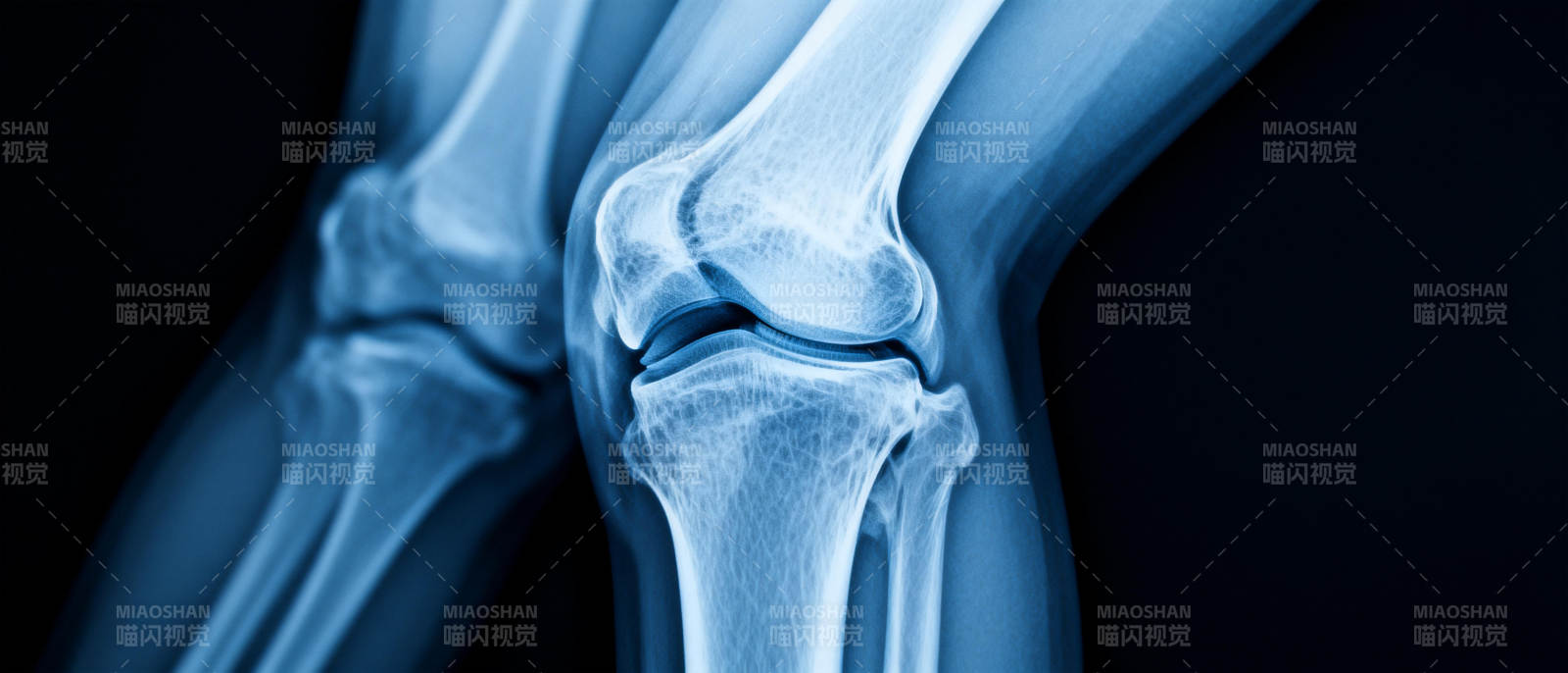 膝关节X光影像图片