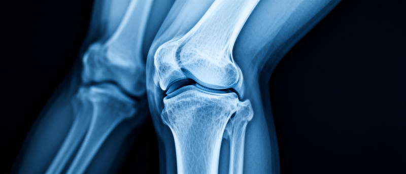 膝关节X光影像图片