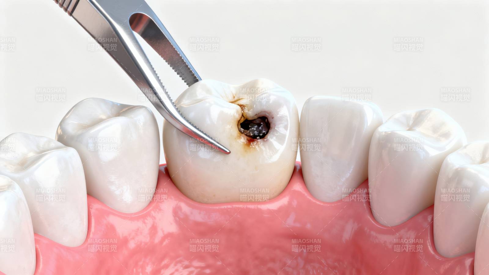 蛀牙治疗牙齿修复图片
