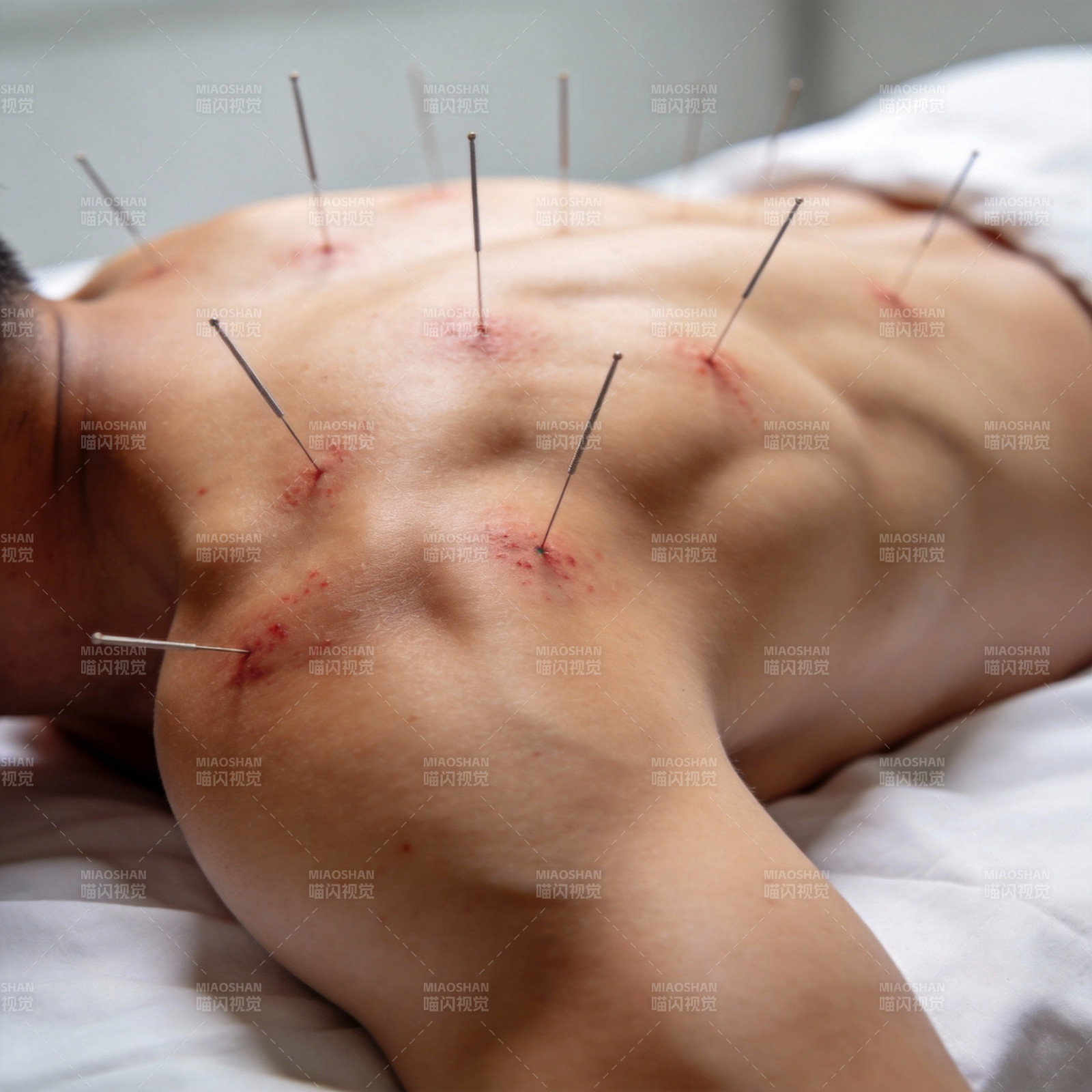 针灸治疗背部图片